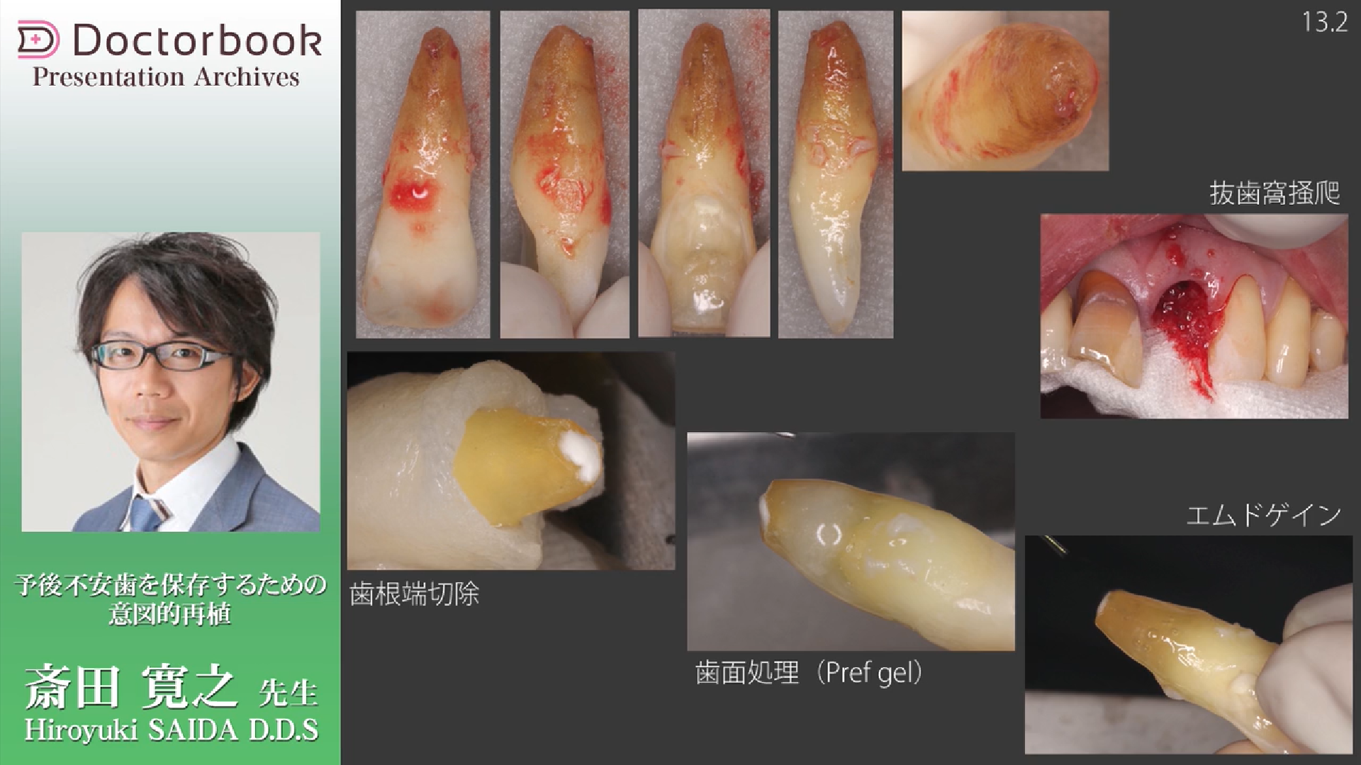 天然歯を限界まで残す！外科的歯内療法最前線 | Doctorbook academy
